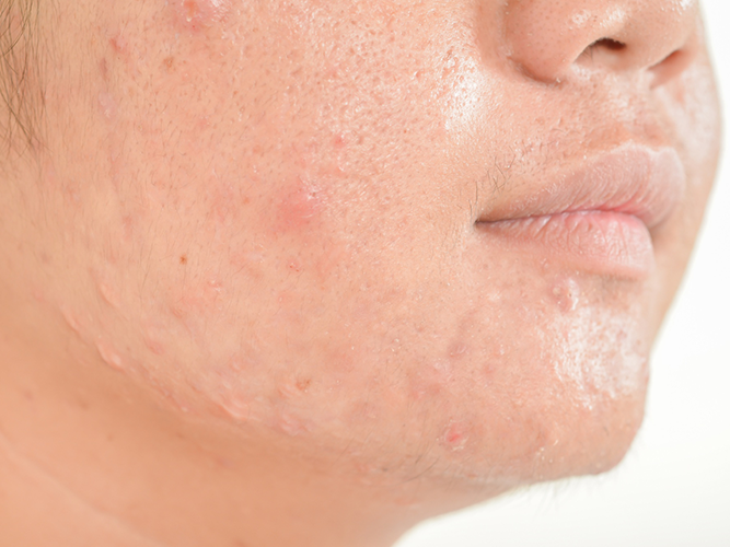 Acne Prone Skin