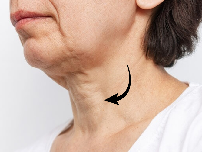 Lose Skin around the neck