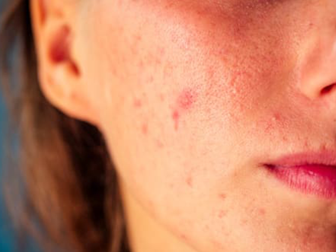 Acne Scars