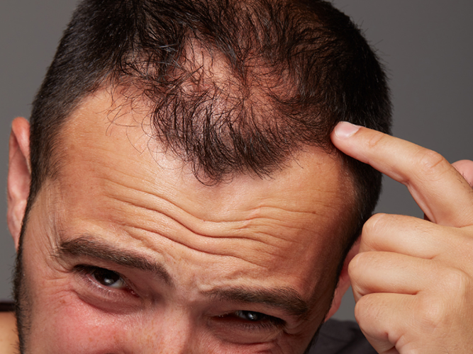Androgenetic Alopecia