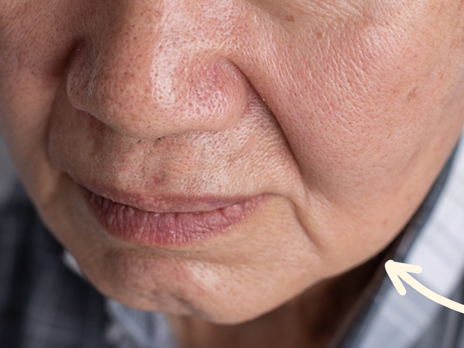 Facial Jowls