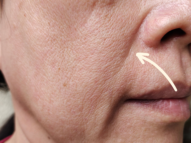 Nasolabial Folds