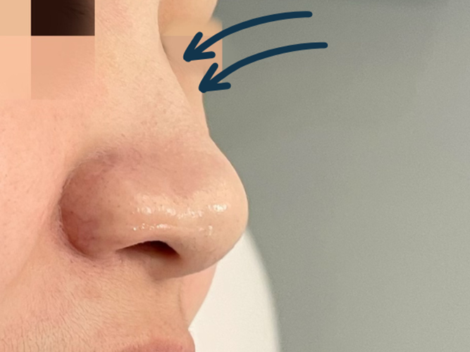 Sunken Nose bridge or Nose tip