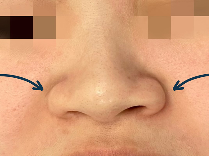 Wide base of Nose